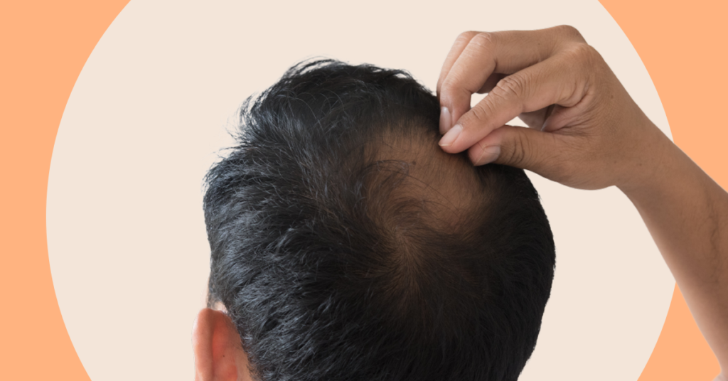 Male Pattern Baldness Causes Treatment Options Andsons Sg