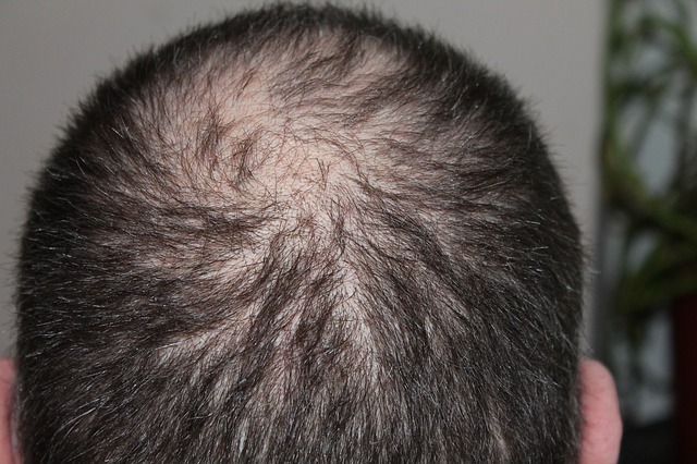 Hair Loss In Men Under 25