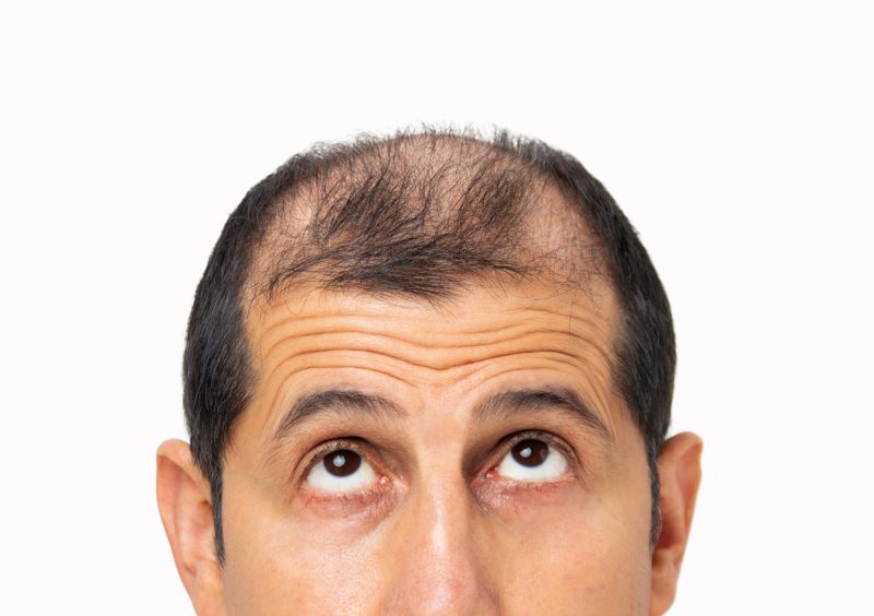 Hair Loss Vs. Hair Thinning Know The Difference