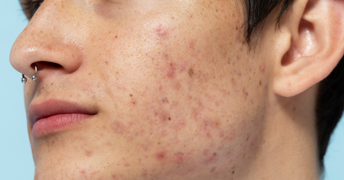 Acne vs acne scars