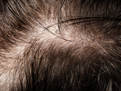 Traction Alopecia