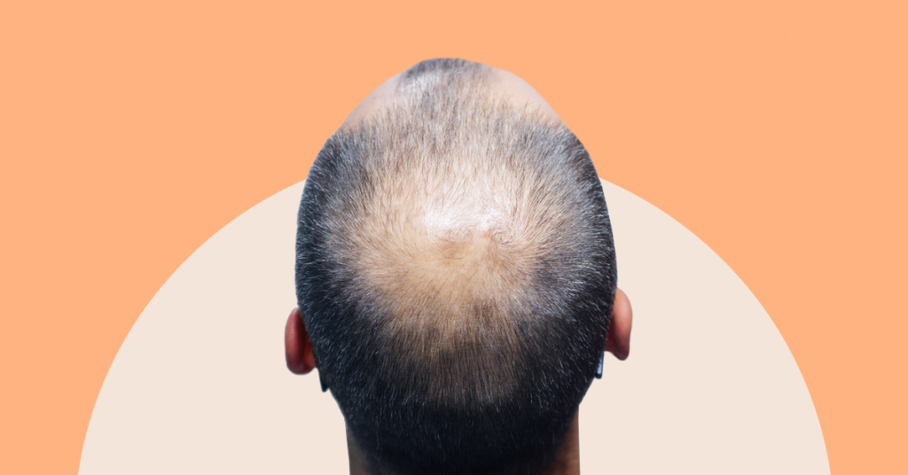 Androgenic Alopecia Causes Stages And Treatments Andsons Sg