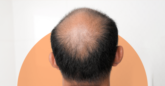 Hair Vitamins vs. Topical Hair Loss Treatments