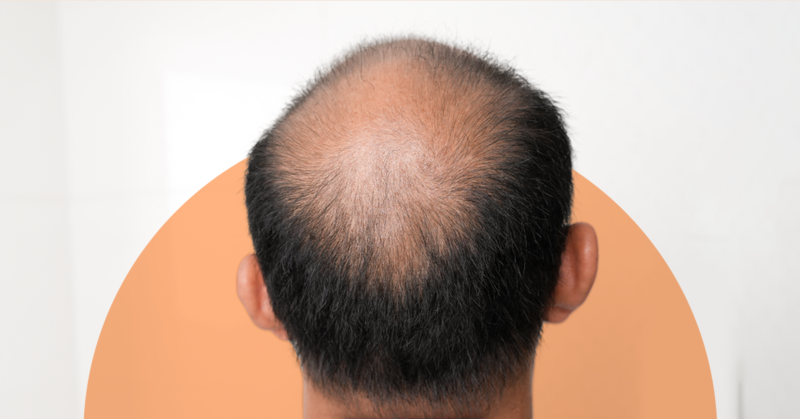 Alopecia Areata - Symptoms, Causes, & Treatment | AndSons SG