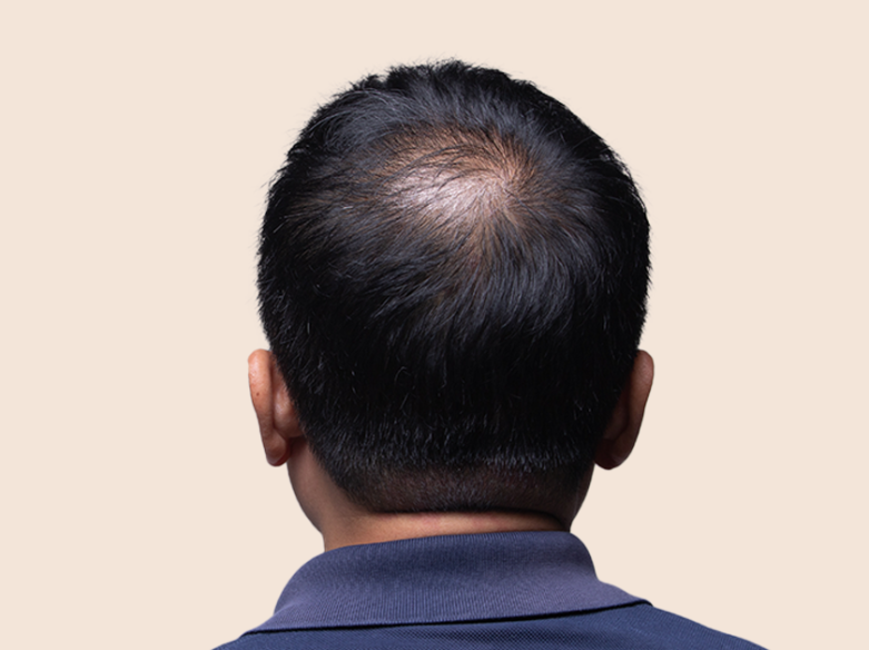 8 Best Hair Loss Treatments For Men In 2023 Andsons Sg