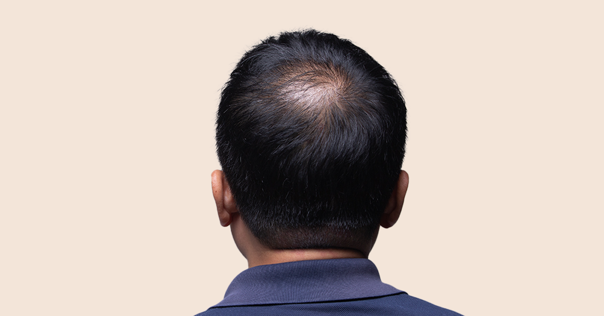 Is Your Dry Scalp Causing Hair Loss
